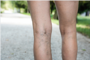 Varicose vein treatment Adelaide: Varicose Vein Treatment and Prevention